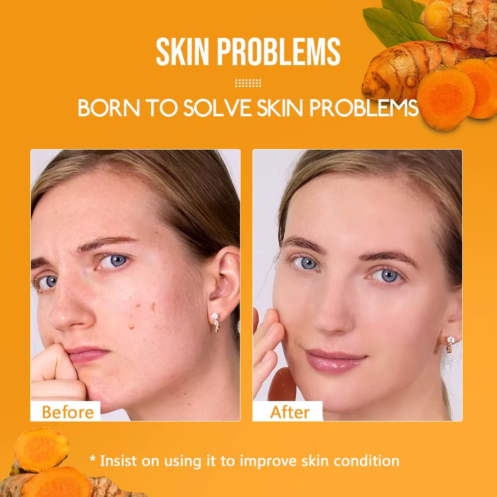 8Pcs Turmeric Skin Care Set Face Brighten Lighten Dark Spots Freckles Acne Scars Melanin Repair Antioxidant Facial Clean Beauty